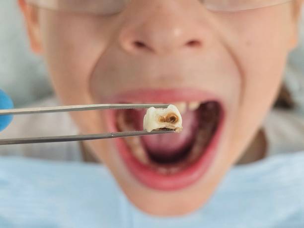 Best Same-Day Emergency Dental Services in Demopolis, AL